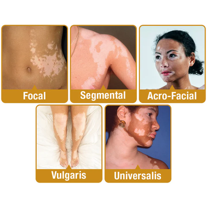 Fivfivgo™ BeeVenom Vitiligo Treatment Cream