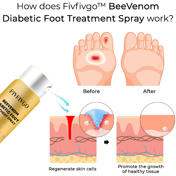 Fivfivgo™ BeeVenom Diabetic Foot Treatment Spray