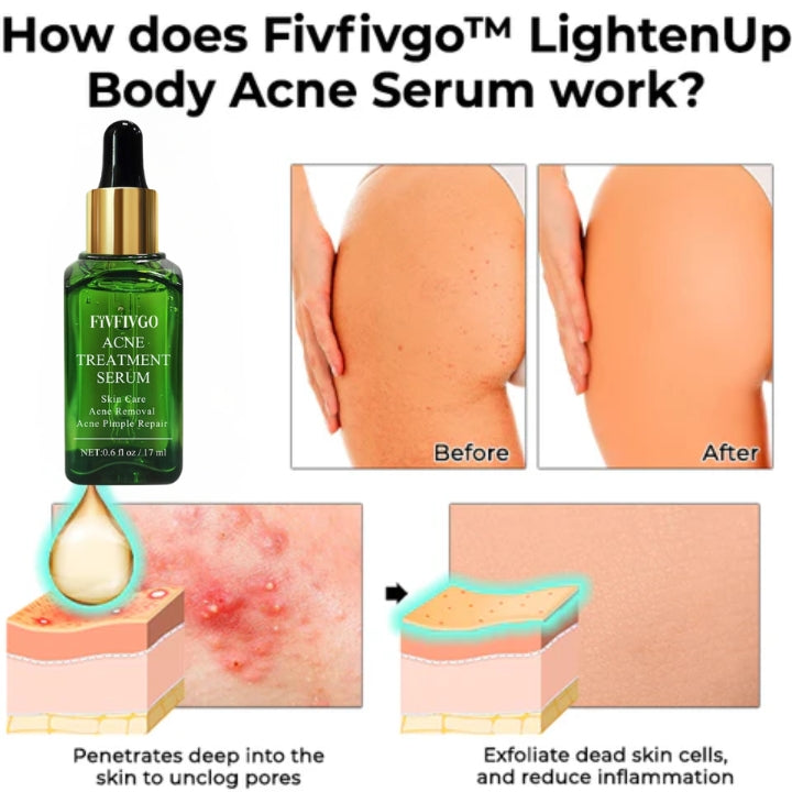 Sérum contre l'acné corporel Fivfivgo™ LightenUp (pour l'élimination de l'acné, des taches et de l'acanthosis nigricans)